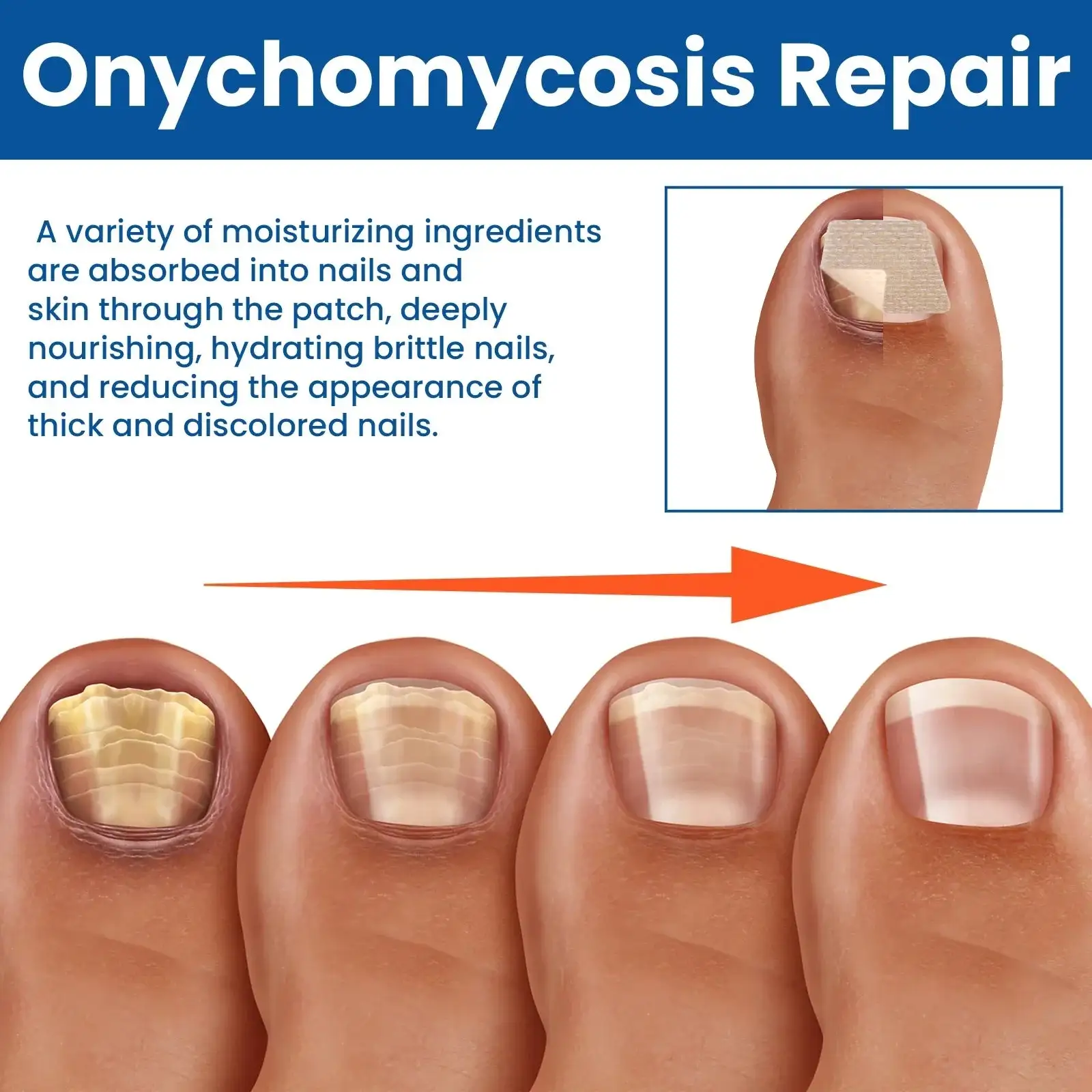 Plesňové náplasti na opravu nechtov – Obrázok 4